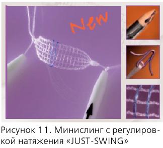 Синдром внутренней обтураторной мышцы лечение