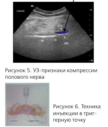 Синдром внутренней обтураторной мышцы лечение