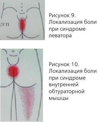 Синдром внутренней обтураторной мышцы лечение