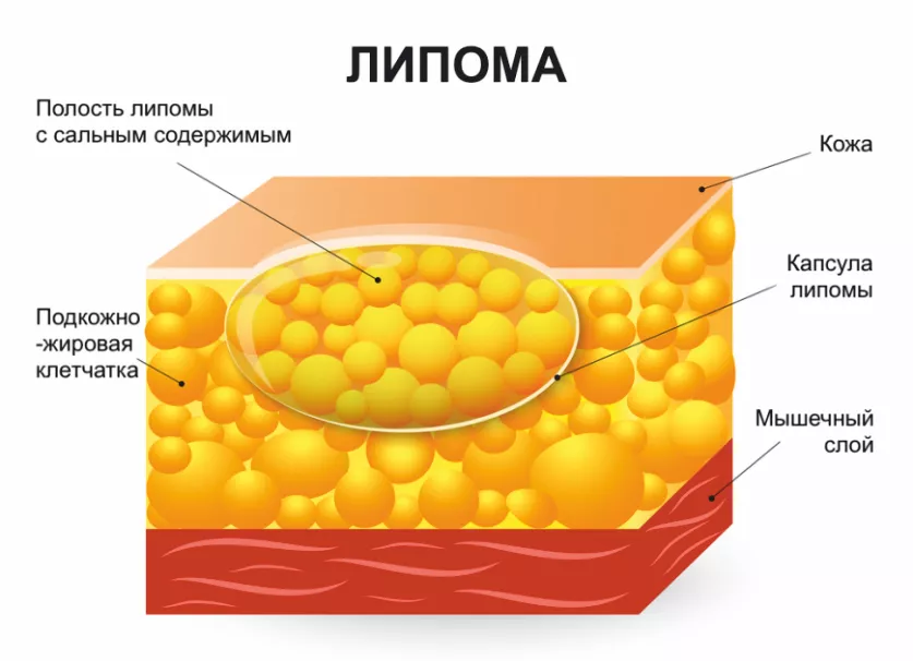 Липома на спине - признаки, причины, симптомы, лечение и профилактика - miel-narofominsk.ru Гемангиома