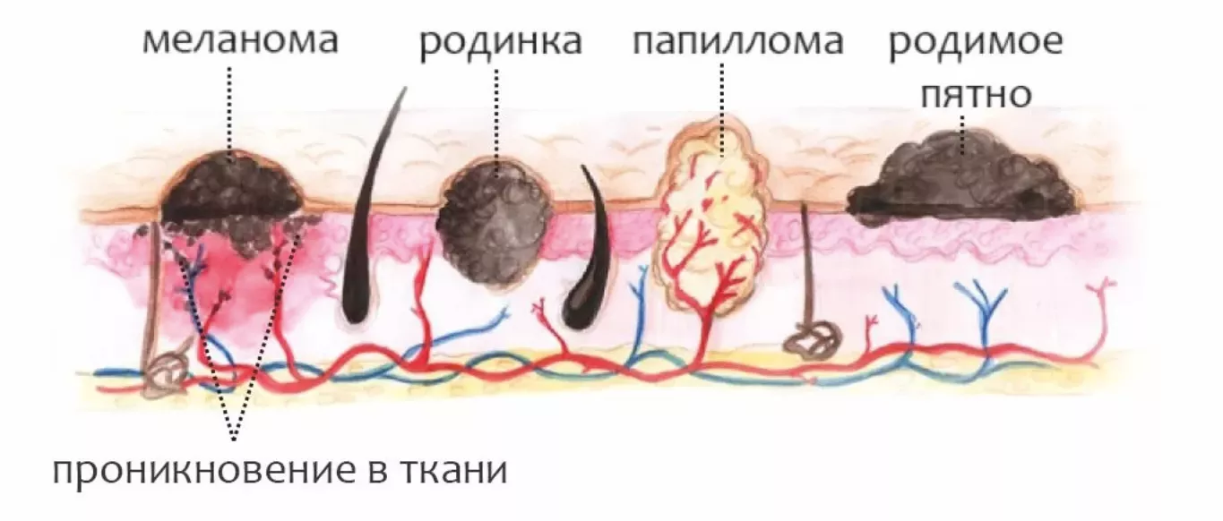 Внутрипротоковые папилломы молочной железы
