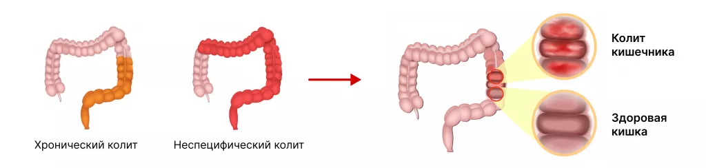 Народные средства от запора: какие бывают и как правильно применять? - FitoBlog