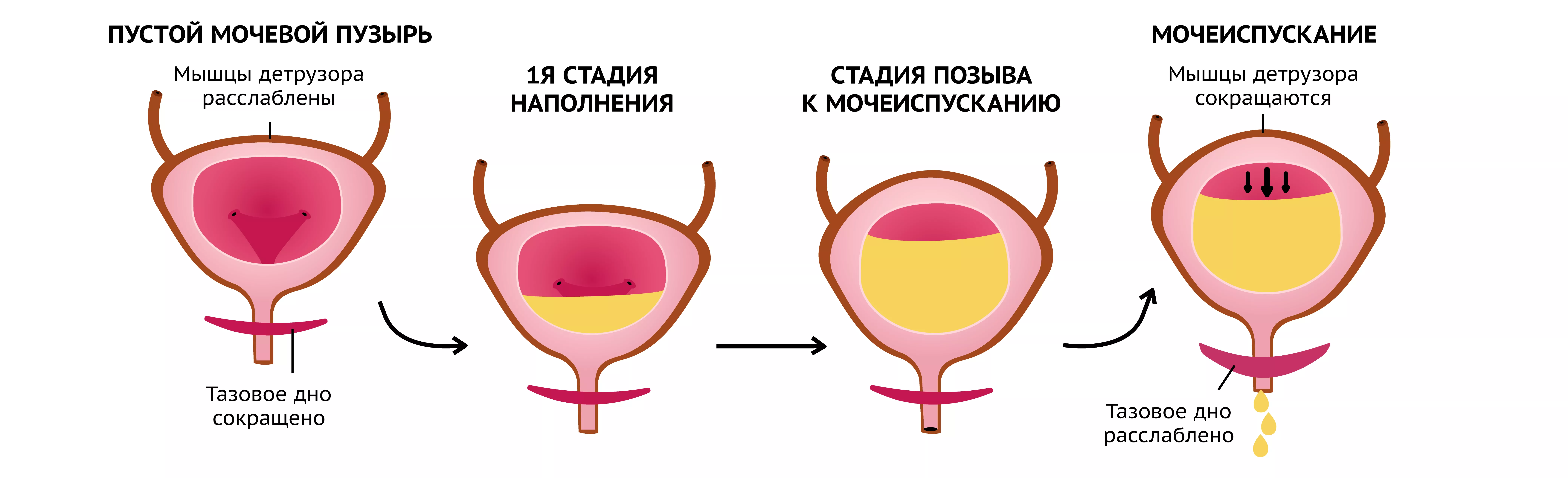 Гиперактивный мочевой пузырь (ГАМП)