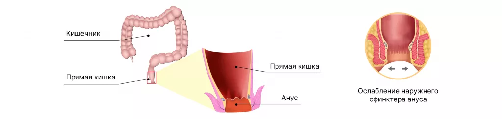 Недержание кала после операции на прямой кишке.