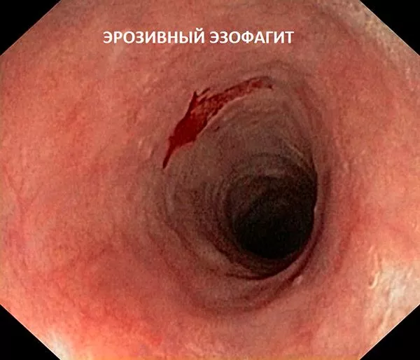 Гастроэзофагеальная рефлюксная болезнь: симптомы и лечение