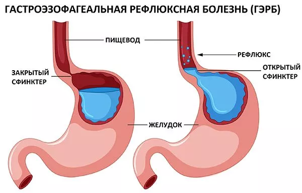 Гастроэзофагеальная рефлюксорная болезнь