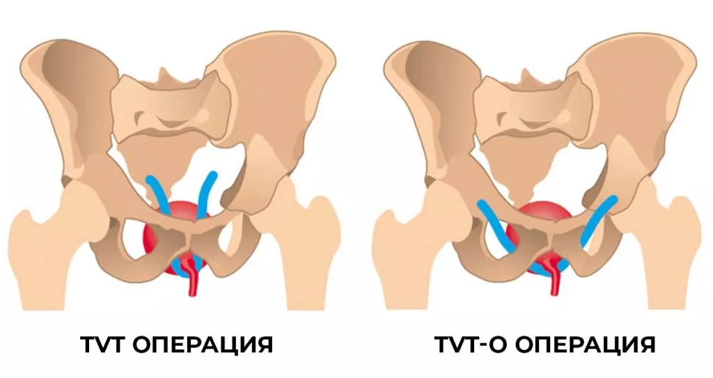 Лечение недержания мочи в Краснодаре. Клиника УРО-ПРО